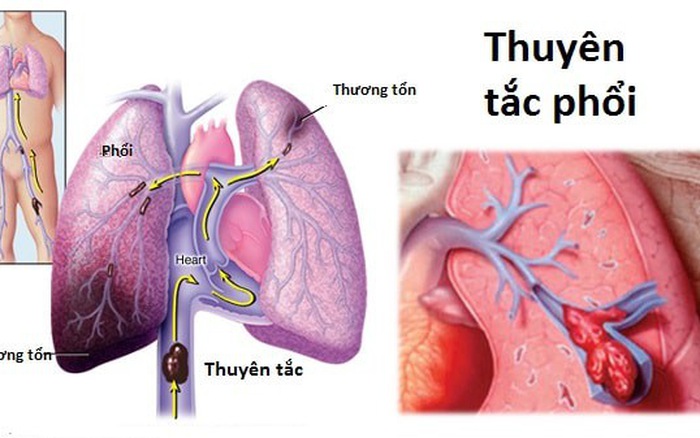 Bệnh Thuyên tắc phổi: Nguyên nhân, biến chứng và cách điều trị